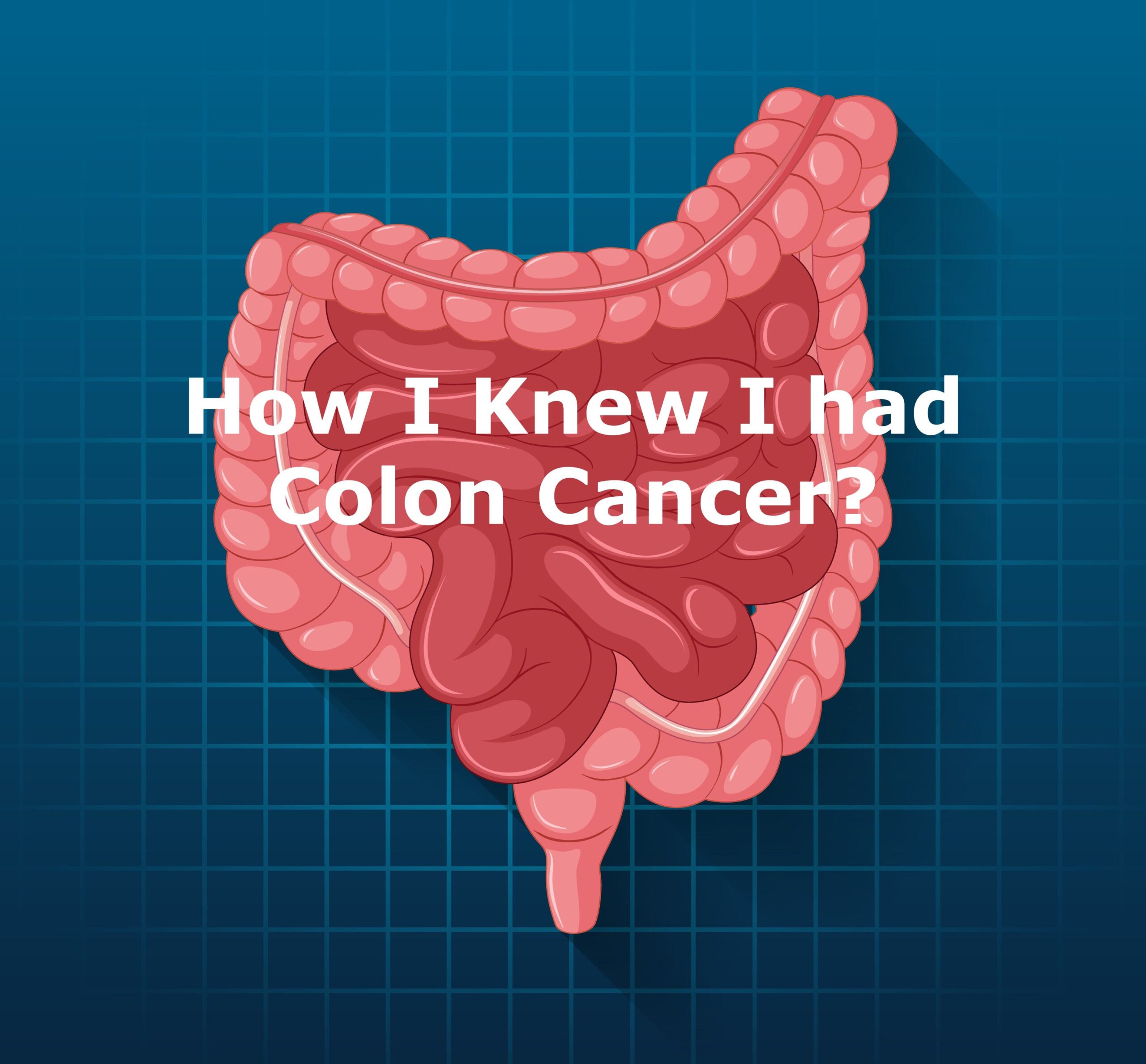 The Colon, How I Knew I had Colon Cancer