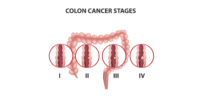 How I knew I had Colon Cancer