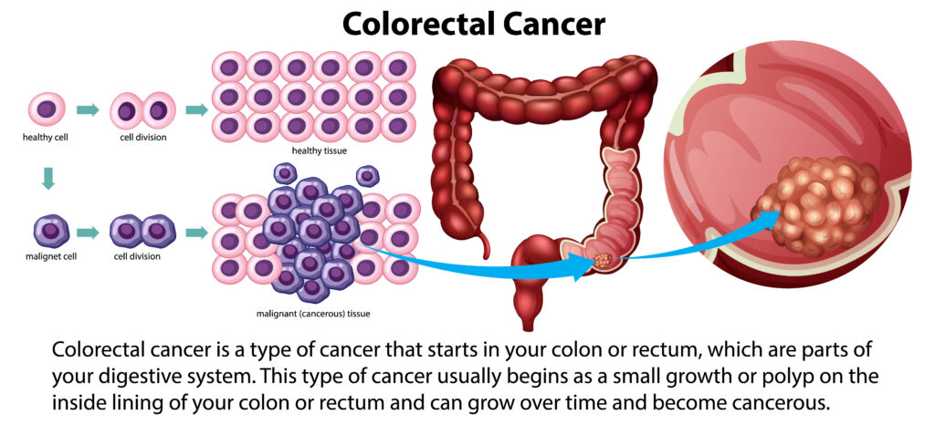 How I Knew I had Colon Cancer