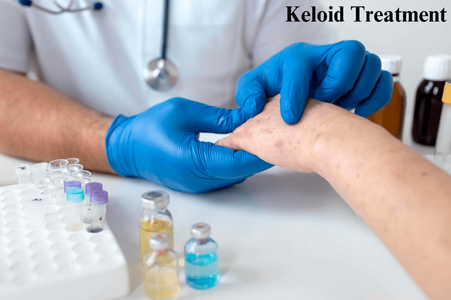 Keloid Treatment