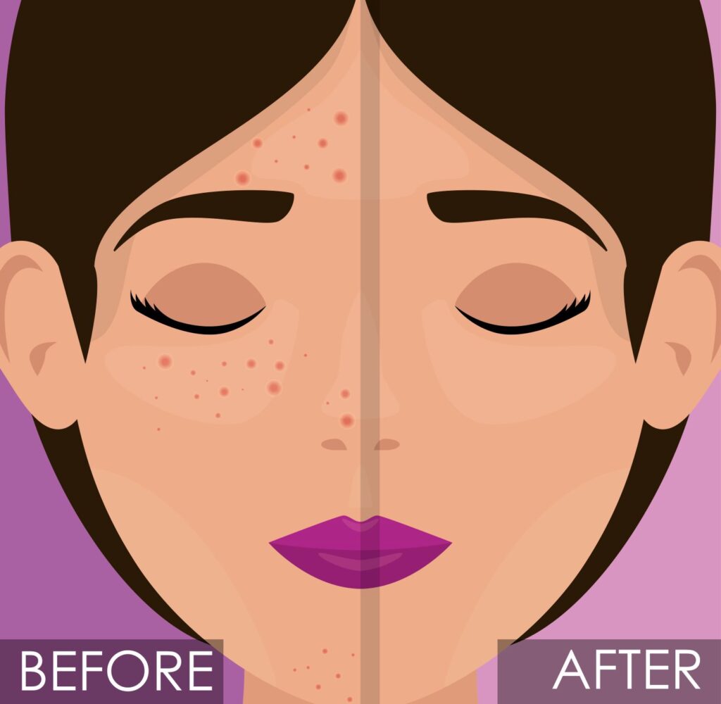 Microneedling Before and After, before and after microneedling