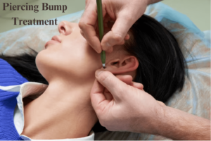 Piercing Bump Treatment