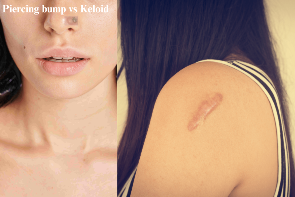 Piercing Bump Vs Keloid Differences And Treatment Options