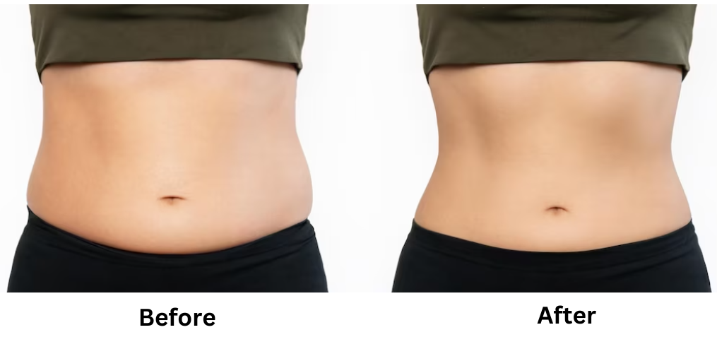 coolsculpting results stomach