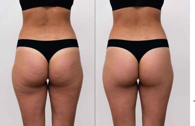 Before and After Hip Dips: Causes, Effective Methods and Impacts