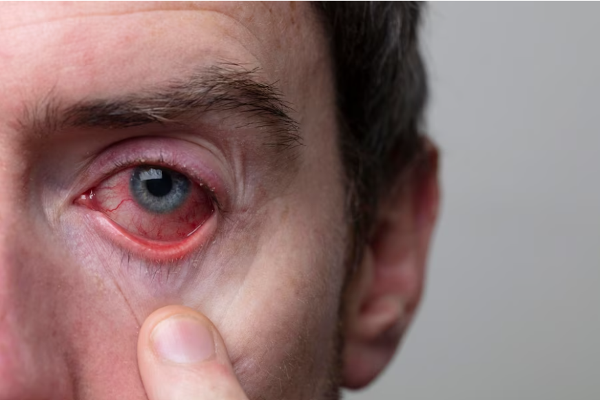 What is Commonly Misdiagnosed as Pink Eye